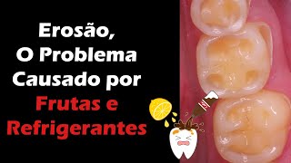 Erosão Dentária  Descubra Como Tratar o Desgaste Dentário Causado por Frutas e Refrigerantes [upl. by Aschim]