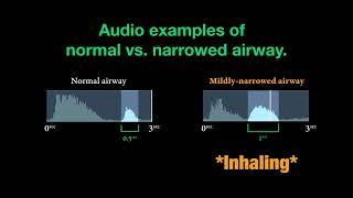 Trouble Breathing How to Hear a Narrow Airway due to Tracheal Stenosis [upl. by Aekin]