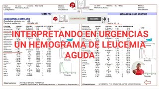 LEUCEMIA AGUDA CLAVES EN LA INTERPRETACIÓN DEL HEMOGRAMA [upl. by Yerroc591]