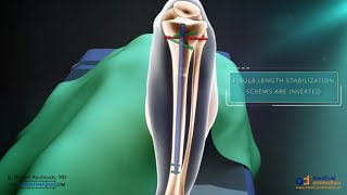 Precice Tibia Lengthening Surgical Animation [upl. by Melvena]