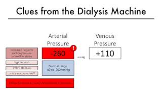 Hemodialysis Access 101 04 Part 2  Clues from the Dialysis Machine [upl. by Eerehc]