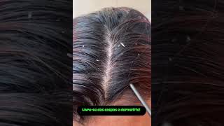 Dermatite seborreica beleza tricologia terapiacapilarintegrativa cabelo clinicacapikar [upl. by Zebulen]