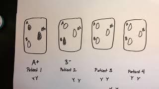 ABO Blood Typing Vid8 Draw Agglutination HCSP21 [upl. by Aimac]