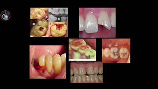 Conservative dentistry  introduction حشوات الأسنان  مقدمة [upl. by Campagna]