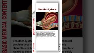 Shoulder Dystocia shoulder shoulderdystocia pregnancy [upl. by Anrol]