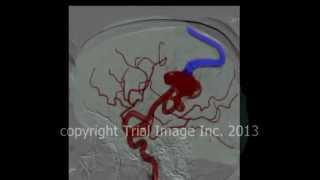 AVM  arteriovenous malformations in the brain amp cerebral hemorrhage animation by Cal Shipley MD [upl. by Gresham]