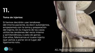 Reconstrucción de ligamento cruzado anterior [upl. by Mastrianni]