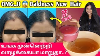 OMG😱 Baldness Hair Growth Treatment  frontal baldness hair regrowth in tamil  Jegathees meena [upl. by Brandie]