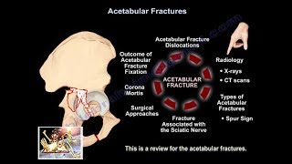 A Review Of Acetabular Fractures  Everything You Need To Know  Dr Nabil Ebraheim [upl. by Gillian]