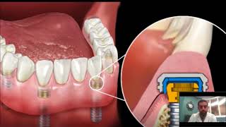 Dental Implant Overdenture  SnapIn Dentures [upl. by Charleton560]