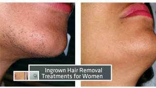 Laser Hair Removal Miami  Before amp After Results [upl. by Enneicul]