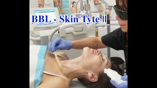 BBL SkinTyte Laser  Dr Victoria Karlinsky  Bellini [upl. by Einamrej332]