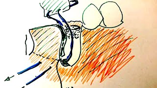 Suturing a membrane to the periostium for a one wall defect bone graft around dental implant [upl. by Eenafets]