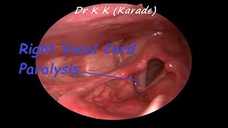 Right Vocal Cord Paralysis after upper respiratory track viral infection [upl. by Lebiram]