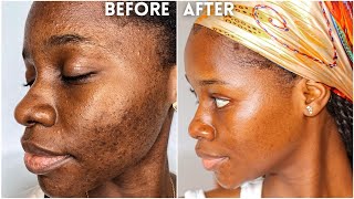 How I cleared my 8 years ACNE amp HYPERPIGMENTATION  How I got rid of textured skin amp got GLASS SKIN [upl. by Gord]