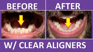 Invisalign Braces Before and After Overbite Crowding Teeth Cost Pain Tips 3M Clear Aligners [upl. by Osei691]