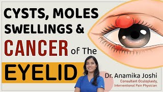 What are these swellings around the eye   Eyelid  Swellings on eyelid  Dr Anamika Joshi [upl. by Ermentrude]