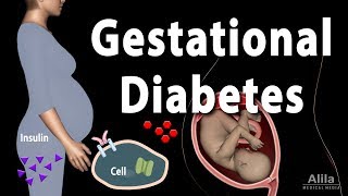 Gestational Diabetes Animation [upl. by Yance900]