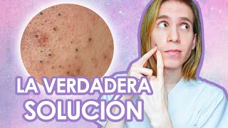 PUNTOS NEGROS Como tratar y prevenir los comedones abiertos  Recomendaciones de un dermatologo [upl. by Mobley621]