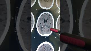 INTRACRANIAL CALCIFICATION doctor hospital  shorts video [upl. by Dagmar]