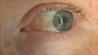 Episcleritis a benign inflammatory eye condition before and after treatment [upl. by Spieler]