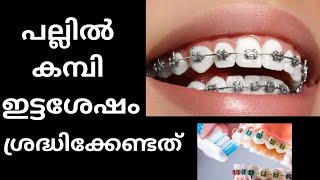 പല്ലിൽ കമ്പി ഇട്ടിട്ടുണ്ടോ ശ്രദ്ധിക്കേണ്ടത്bracesbracestreatment orthotreatment malayalam [upl. by Barthelemy]