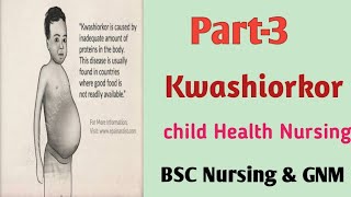 Kwashiorkor20 October 2020 [upl. by Valerie273]