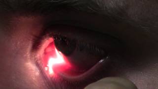 Ophthalmic Skills Video  Basics in Slit Lamp Examination [upl. by Llerrehs]