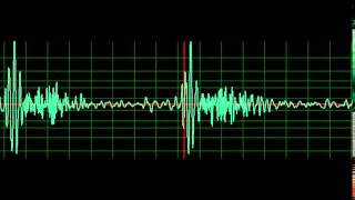 Mitral Regurgitation normal speed [upl. by Arama]