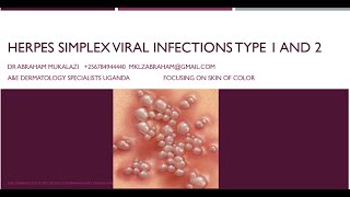 HERPES SIMPLEX VIRUS 1 amp 2 INFECTIONSeducation funny skincondition std skindisease [upl. by Bethel]