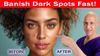 See a Change in 24 Days Banish Dark Spots Hyperpigmentation Melasma amp Acne Scars Dr Mandell [upl. by Eveleen630]