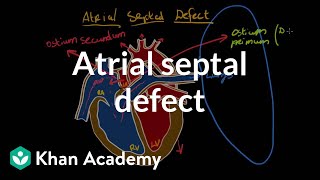 Atrial septal defect  Circulatory System and Disease  NCLEXRN  Khan Academy [upl. by Rabassa]