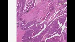 Histopathology KidneyTransitional cell carcinoma [upl. by Annohs]