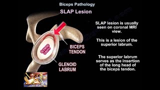 SLAP Lesion  Everything You Need To Know  Dr Nabil Ebraheim [upl. by Aihsyla]