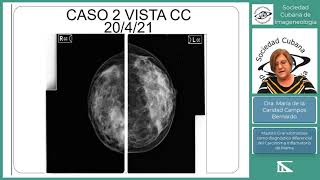 Mastitis granulomatosa diagnóstico diferencial del cáncer de mama Dra Maria Caridad Campos [upl. by Maharba]