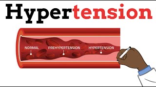 Hypertension  Best for beginners Risk factors Pathophysiology Causes Diagnosis Medications [upl. by Omrellig]