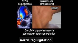 aortic regurgitation signsdancing carotid corrigans sign Sudarshanlipane17 ✨⛑️🏥🏥✨🏆🧪💉💉 [upl. by Cassy]