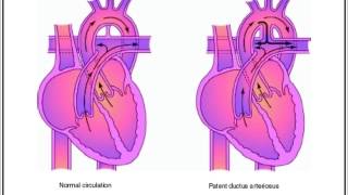 Heart SoundsPatent Ductus Arteriosus [upl. by Oiraved]