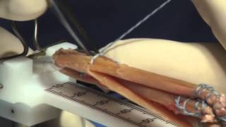 Hamstring Autograft Technique for ACL Reconstruction Surgery [upl. by Ellynn]