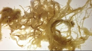 Huge Big Daddy Octopuslike Parasite Removal with Coffee Enema amp Urine Therapy WARNING GROSS [upl. by Longerich]