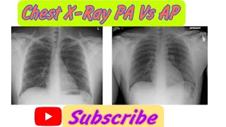 PA Chest XRay Vs AP Chest XRay  How to Recognise Whether a CXR is PA or AP [upl. by Nakashima]