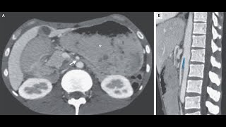 Arteria mesenterica superior Syndrom [upl. by Gerry]