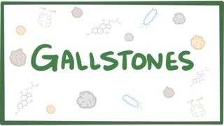 Gallstones cholelithiasis [upl. by Mencher28]