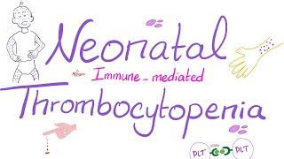 Neonatal ImmuneMediated Thrombocytopenia [upl. by Daffi]