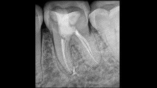 Case Demonstration  Conservative Endodontics in 36 with Class V caries [upl. by Elleiram]