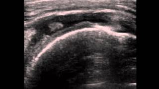 Supraspinatus Full Thickness tear on ultrasound [upl. by Ahsitel]