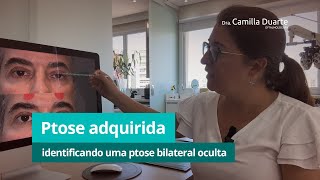 Cirurgia de Ptose entenda a Importância de um Diagnóstico Completo [upl. by Atalya]