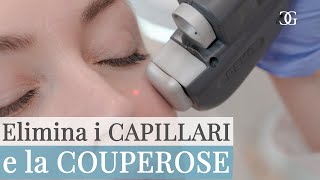 Come eliminare i CAPILLARI e la COUPEROSE con il LASER  Drssa Beatrice GIORGINI [upl. by Atilegna]