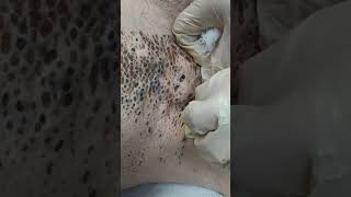 Nevus Comedonicus removal [upl. by Gawen]