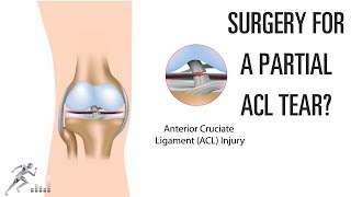 Do you need surgery for a partial ACL tear [upl. by Kemp]